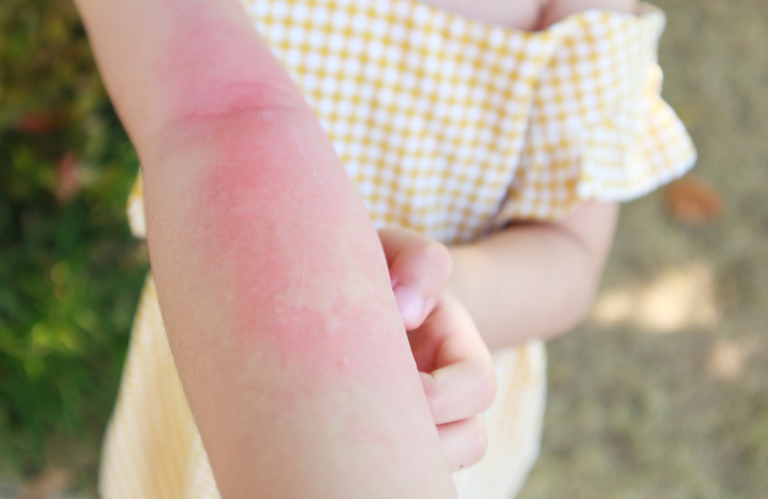 โรคผื่นลมพิษ เกิดจากอะไร สาเหตุ อาการ และวิธีป้องกัน